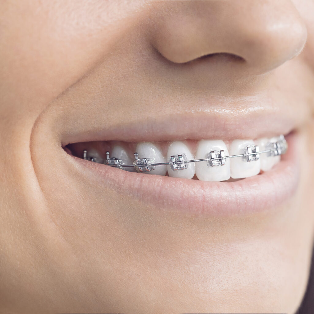 metal-braces-shepherds-bush-ceramic-braces-hammersmith